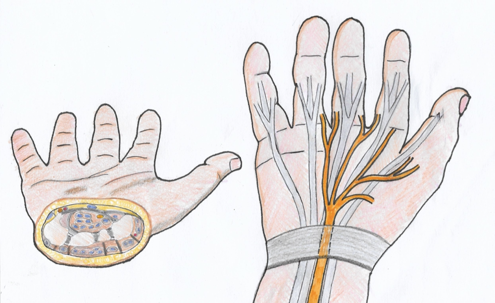 Sindrome del tunnel carpale - TRATTAMENTO ENDOSCOPICO/ECOGRAFICO MININVASIVO