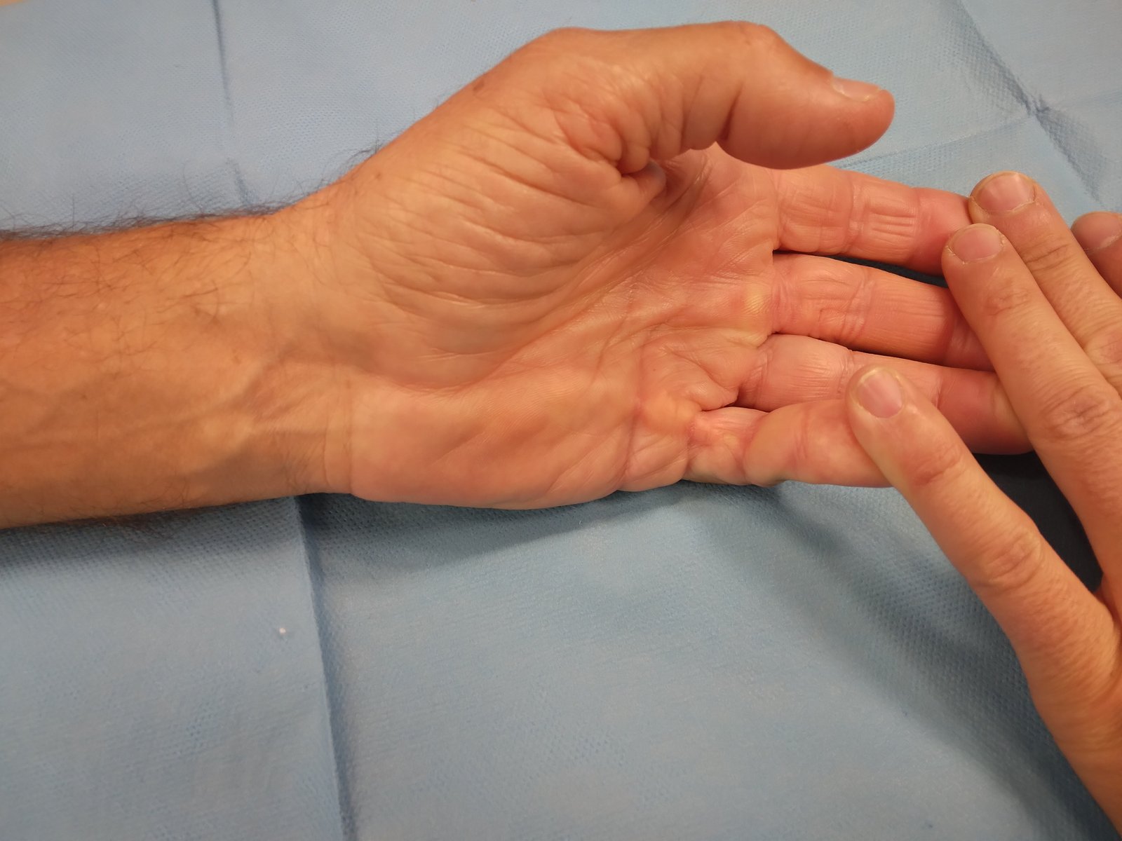 Morbo di Dupuytren - aponeurectomia minivasiva e cordotomia