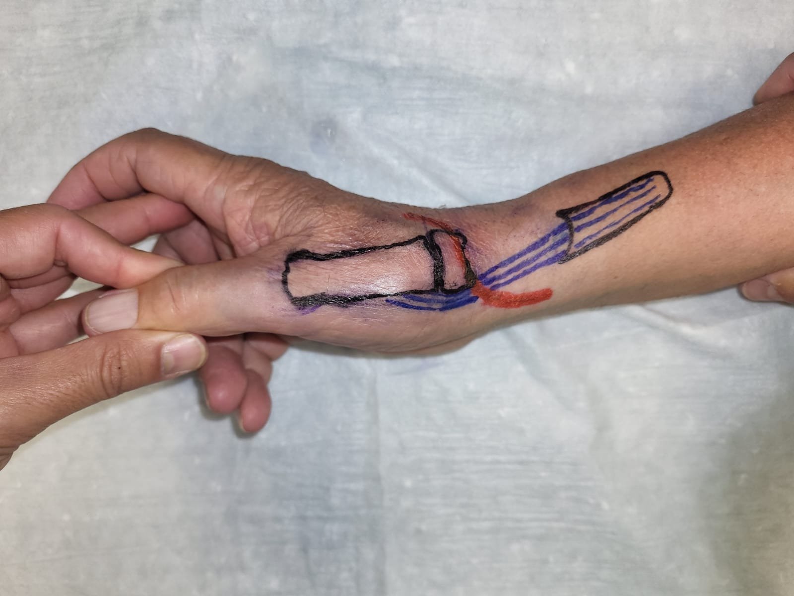 Sindrome di De Quervain