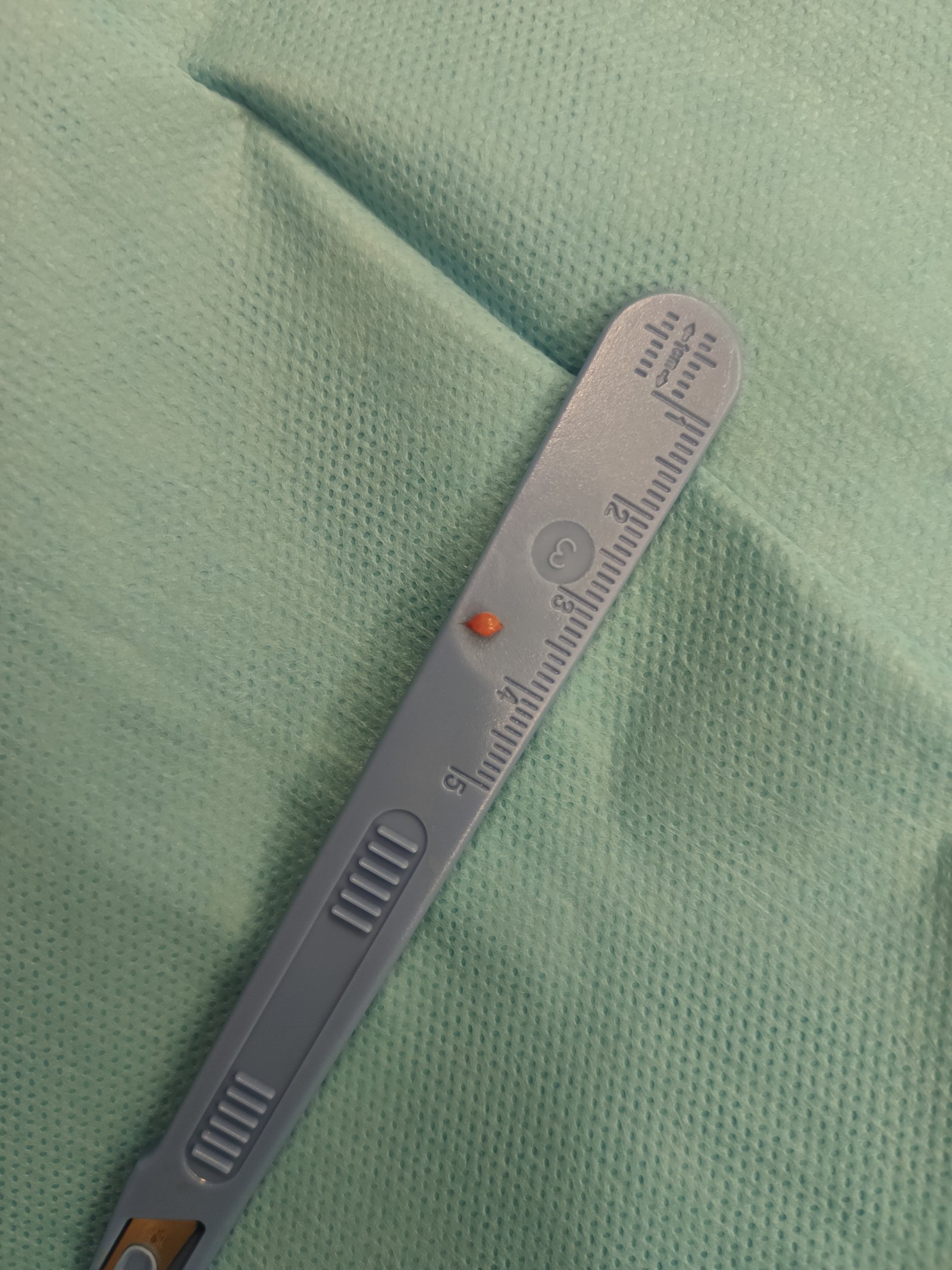 Tumore glomico delle dita